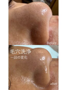 ベルティ(Bellti)/毛穴洗浄