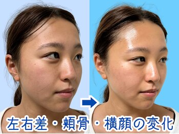 ナチュラルパーフェクトフェイス 新宿/１回で変わる小顔矯正／新宿小顔