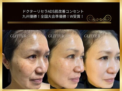 グリッター(GLITTER)の写真