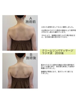 からだの総合整骨院 高田馬場店/首肩こり/巻き肩/肩甲骨はがし
