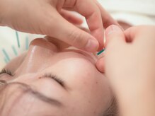 エアーストリーム 前橋店(AIR STREAM)/即効性も魅力の美容鍼♪