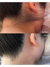 エリス(ELISSE)/ダブル脱毛でその日に同じ美人に