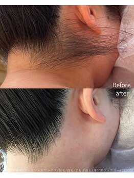 エリス(ELISSE)/ダブル脱毛でその日に同じ美人に