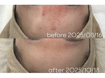 アンリミット 下北沢店(Une limit)/【頑固な肌荒れに】