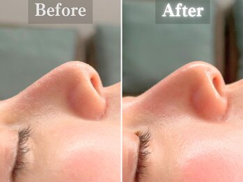 ボーンオム(Born Homme)/毛穴洗浄+美容液導入:20代女性