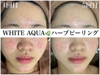 アワピール 天王寺店(AWA PEELL)/ハーブピーリング/ニキビケア