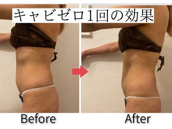 エトワール(etoile)/キャビテーション×EMS/痩身