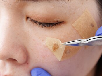 リバース 大宮(Re:Birth)の写真/【顔印象を変える、シミケア革命。】肌本来の力をサポートしシミ悩みから卒業。土台から明るい肌へ♪