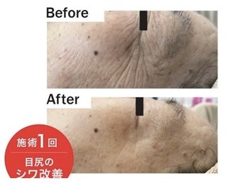 ラバンサラ(Ravan Sara)の写真/小顔も美肌も叶えたい!韓国最新肌管理。ピーリング!セラピール×ポレーションで、引き締まったツヤ小顔へ