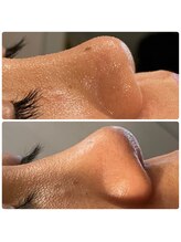 ハーシークレット(Her secret)/ハイドラ毛穴洗浄