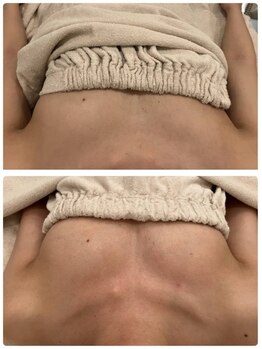 美人バスト 豊橋店/バストアップ症例【バストケア】