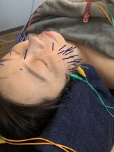 アクアラボ(AQUA Labo)/【美容鍼】内側から美しく