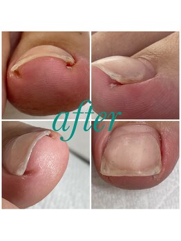 ラピス(Lapis)/巻き爪ケア★