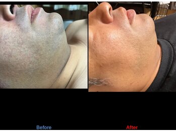 サロン ココ(COCO)/ヒゲ脱毛 10回目 結果