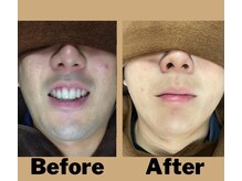 メンズジョイ マツエ(mens's joy MATSUE)/メンズヒゲ脱毛15分/平日¥2990