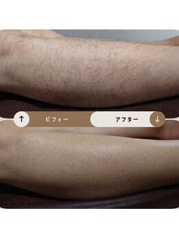 ジュゴン(Dugong)/足の全体脱毛（Before＆After）