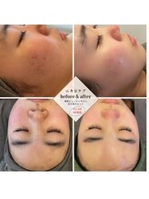 目が美きゅっと/ニキビケア・韓国式肌管理