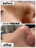 ☆周年価格【気になる部位集中ケア】Tゾーン+あご　鎮静パック付
