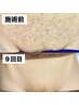 【MEN'S】VIO脱毛　エリア最安値◎