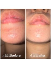 ミニョン(mignon)/梅雨時期前にお手入れを