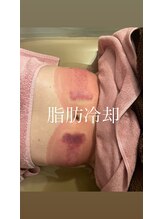 ヴィーナス(Venus)/脂肪冷却