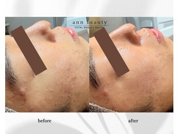 アン ビューティー(ann beauty)/施術1回【症例写真】学生