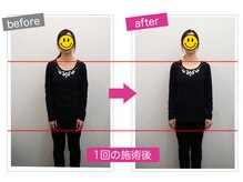 堺駅で肩こり・猫背・巻き肩・ストレートネックに特化した施術◎