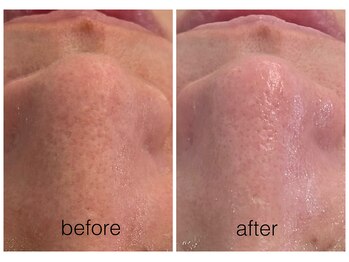 ハリスキンラボ(Hari.Skin.Lab)/40代のお客様/1回の施術効果