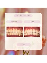 プラスビー 2号店(+b)/ホワイトニングビフォーアフター