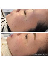 サロンドラニ(salon de LANI)/【シミケア】症例