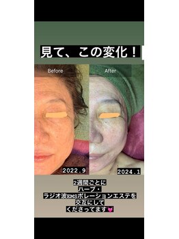 マリー(Mary.)/ハーブピーリング♪