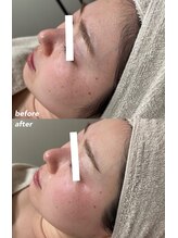 インク(ink)/新メニュー『mix脱毛』