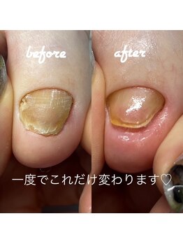 ネイルサロン ユーズ(USE.)/【トラブル爪ケア】フットケア