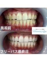 ホワイトニングサロン 熊本店/友達とホワイトニング
