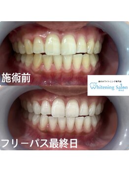 ホワイトニングサロン 熊本店/友達とホワイトニング