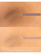 エクスクラメーションマーク(!!!)/色素沈着ケアや黒ずみに！