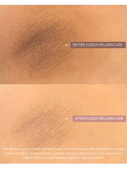 エクスクラメーションマーク(!!!)/色素沈着ケアや黒ずみに!