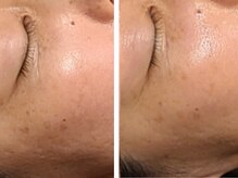 ブラン(BLANC)/シミケアフェイシャルPREMIUM