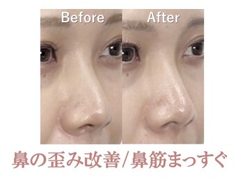 ラプリ 盛岡店(Raplit)/隆鼻＋輪郭矯正40分10回