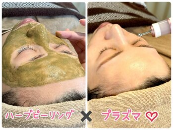 サロン アグランシュ(salon A.glansh)の写真/肌荒れ・ニキビ・毛穴の黒ずみでお悩みの方に【ハーブピーリング×プラズマ¥12000】保湿モデリングパック付
