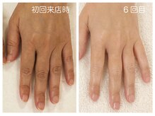 キレイテ 福岡天神店/40代/6回目【天神ハンドケア】