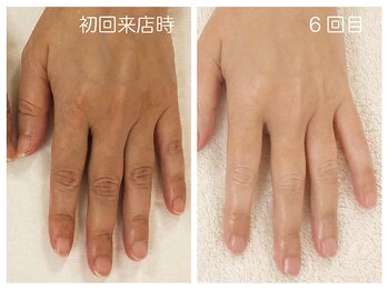 キレイテ 福岡天神店/40代/6回目【天神ハンドケア】