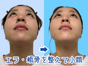 ナチュラルパーフェクトフェイス 新宿/フェイスラインに自信／新宿小顔
