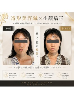 エモシオン トウキョウ(EMOTION TOKYO)/造形美容鍼×小顔矯正