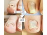 90分【巻き爪】両足を整えるUP GEL親指2本