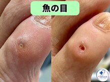 プラスワンフット 本厚木(+1 Foot)/タコ・魚の目ケア！痛みから解放