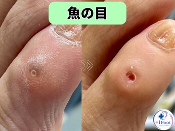 プラスワンフット 本厚木(+1 Foot)/タコ・魚の目ケア！痛みから解放