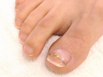 ボヌール(Bonheur)/陥入爪ワイヤー