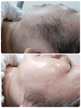 エステシェービングサロン フルール(Fleur)/お顔のうぶ毛ビフォーアフター