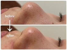 スタコレ スタイルブックコレクションズ 京橋店(Style Book Collections)/毛穴洗浄(１回での効果)